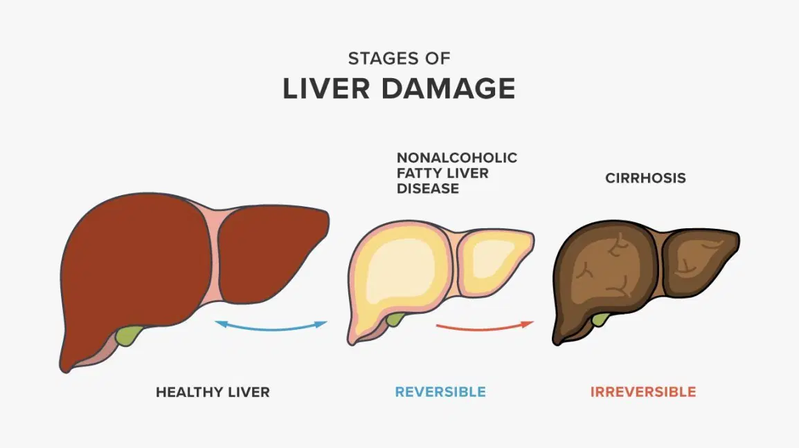 Fatty Liver on the rise in Urban and Rural population in the country- Latest survey reports